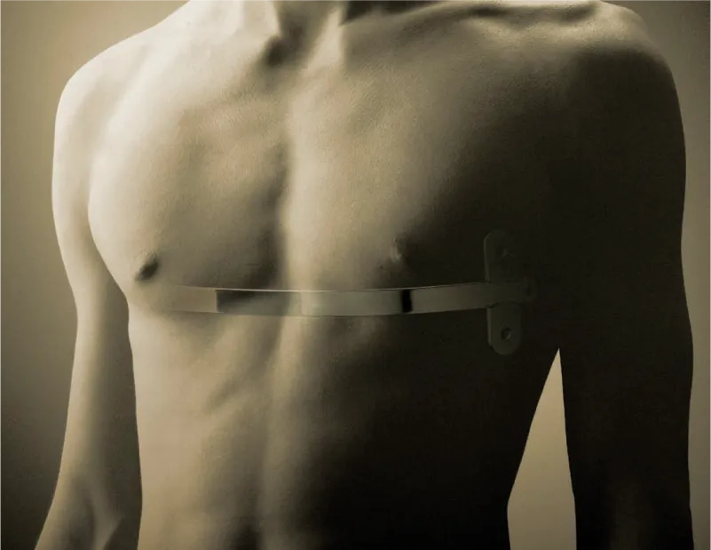 foto del implante barra pectus de zimmer biomet