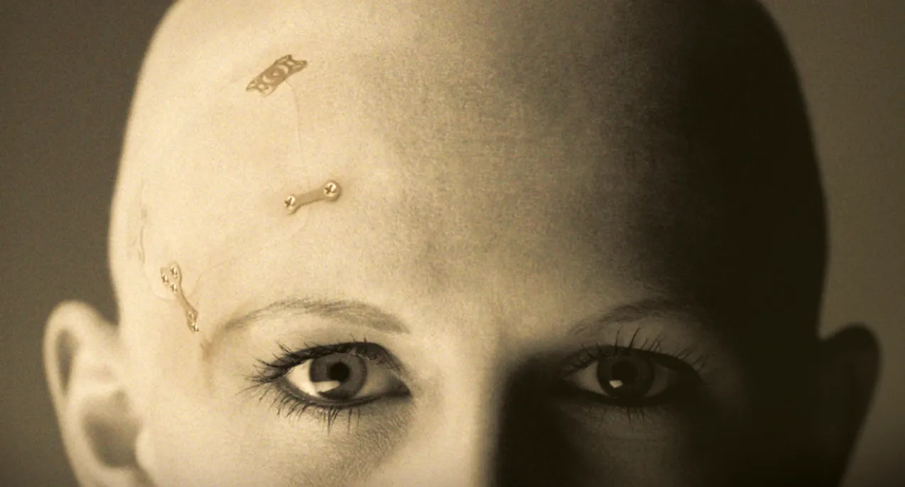 fotografia de implantes thinflap tray marca zimmer biomet colocados