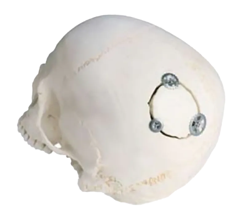 lustración de implantes rapidflap marca zimmer biomet colocados