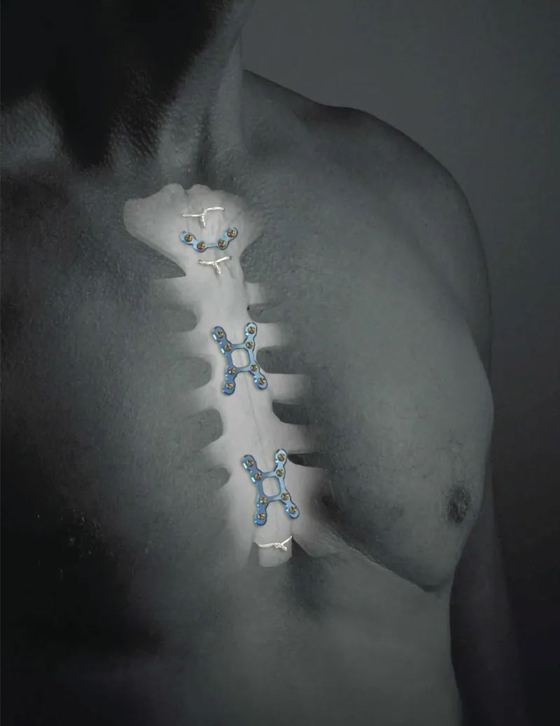 foto de implantes sternalock de zimmer biomet